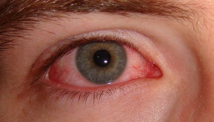 Как распознать и лечить грибок на глазах и веках? Лучшие медикаментозные и народные средства