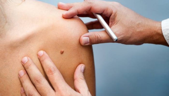 Как проявляется и лечится меланома кожи? Своевременная диагностика опасной болезни