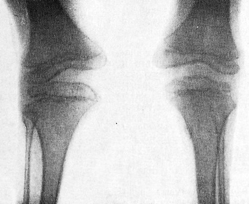 Диастрофическая дисплазия. Фото рентгенограмм коленных суставов ребенка 7 лет.