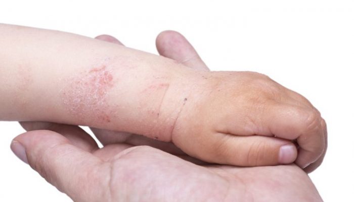 Как выглядит аллергия на порошок у ребенка? Способы лечения и профилактики