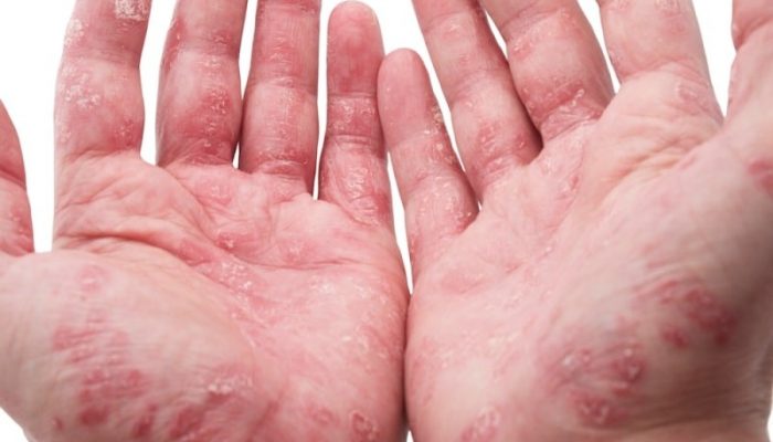 Причины, симптомы и методы лечения псориаза на руках