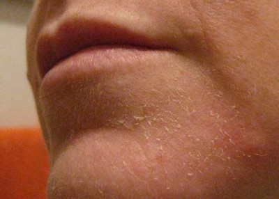 Почему кожа на лице краснеет и шелушится