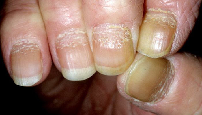 Заболевания ногтей на руках и их лечение