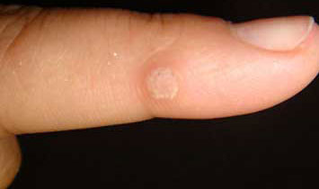 Образование на коже пальца руки thumbnail