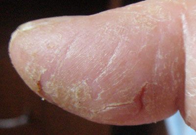 Что делать с потрескавшейся кожей на пальцах рук?