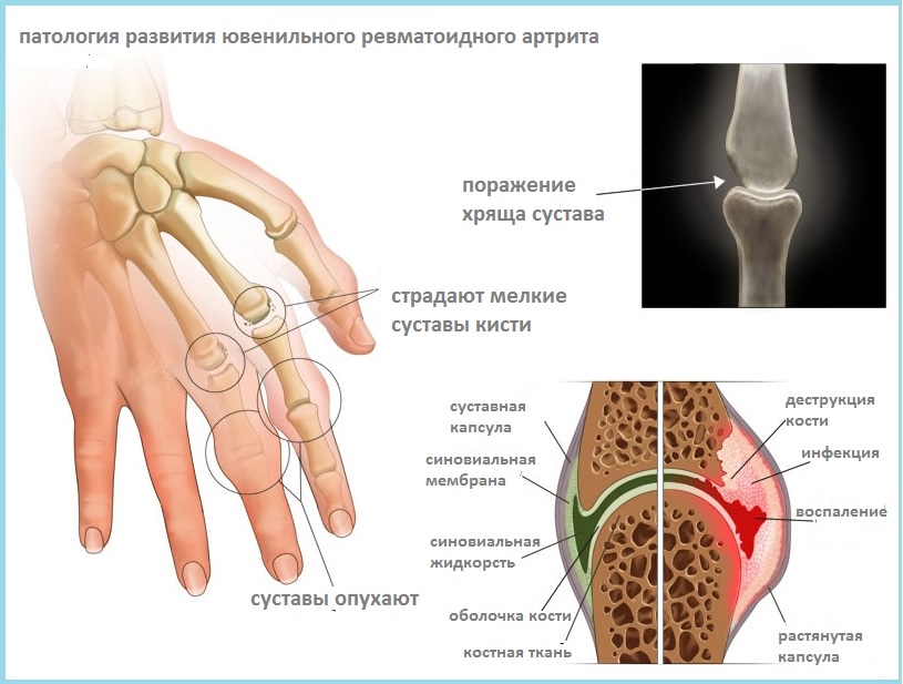 Ювенильный ревматоидный артрит: причины возникновения