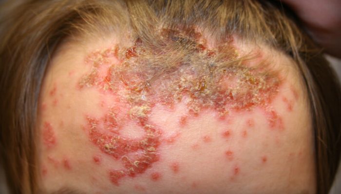 Как лечить кандидоз кожи?