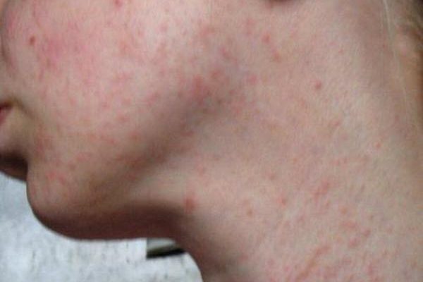 Как отличить сыпь при дисбактериозе у взрослого и ребенка от аллергии и правильно ее лечить?