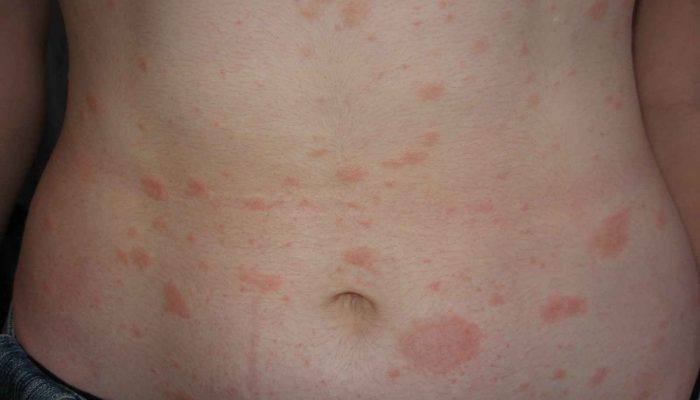 Аллергия на одежду: причины и лечение