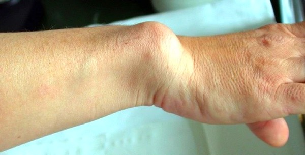 Рука больного мелореостозом