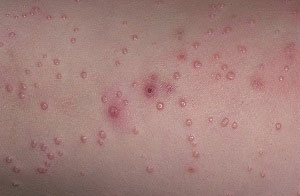 Иинфекционное дерматовенерологическое заболевание контагиозный моллюск на коже