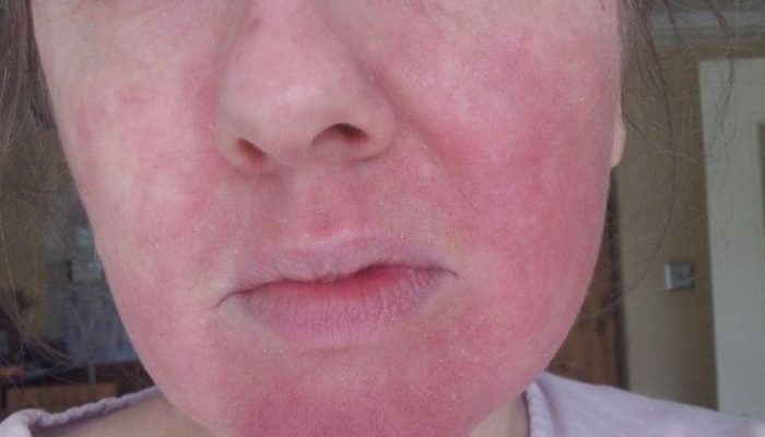 Почему возникает, как выглядит и лечится аллергия на лице?