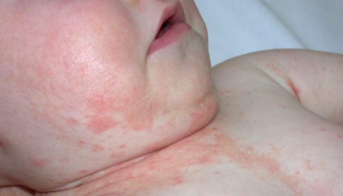 Что такое аллергический дерматит? Симптомы и способы лечения распространенной болезни