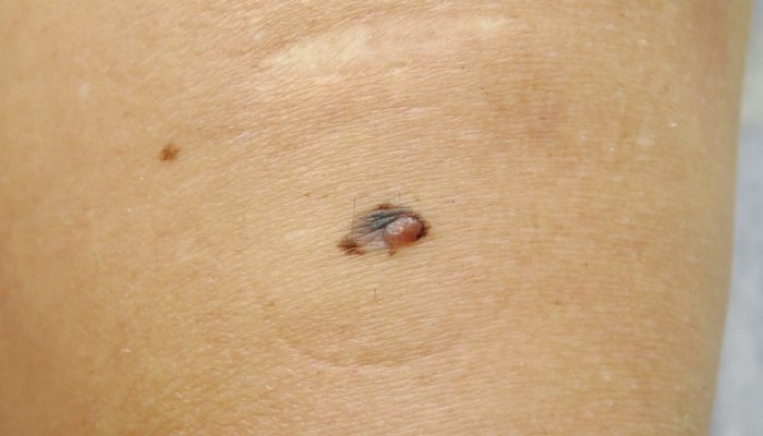 Почему возникает рак кожи? Каковы симптомы и первые признаки болезни? Как лечить онкологию?