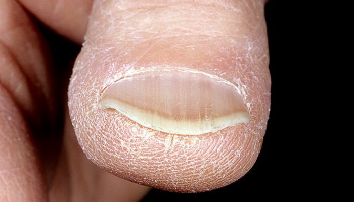 Ложкообразные ногти: причины и лечение