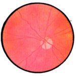 Первичная атрофия зрительного нерва