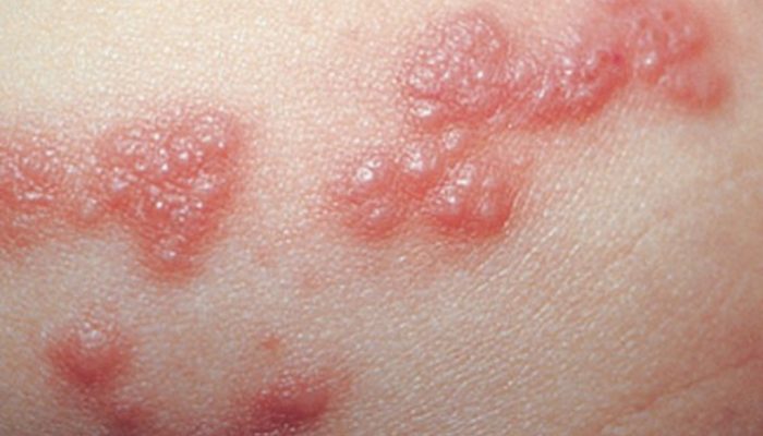 Везикулы на коже: причины и диагностика