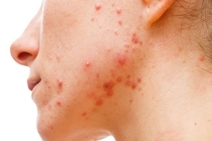 Угревая сыпь acne vulgaris thumbnail