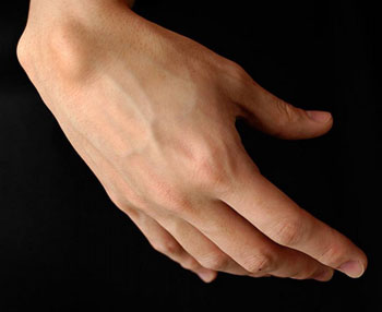 Почему образуется шишка на руке под кожей на запястье и как ее лечить