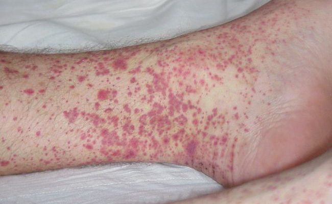 Что за болезнь кожный васкулит и как ее лечить? Мнения специалистов