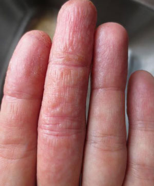 Лечение сыпи на ладонях и пальцах thumbnail