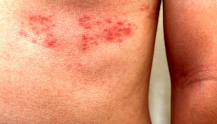 то такое вирусные заболевания кожи? Классификация кожных болезней и краткий обзор