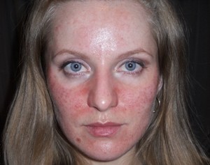 Чувствительная кожа после чистки лица при покраснении thumbnail