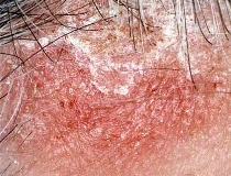 Себорея (себорейный дерматит): формы, причины, лечение