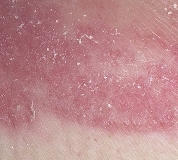 Кандидоз кожи: виды, симптомы и лечение