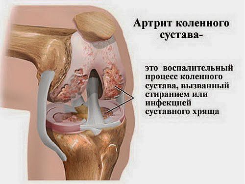 признаки артрита коленного сустава