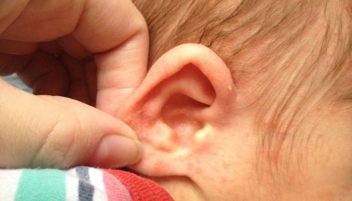 Сыпь на ушах у ребенка и взрослого: причины