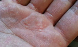 Водяная сыпь на пальцах рук в руки thumbnail