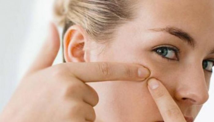 Почему появляются жировики на лице и как от них избавиться? Самые эффективные методы