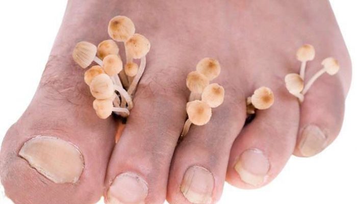 Избавляемся от грибка между пальцами ног быстро и эффективно: лучшие препараты и способы победить микоз