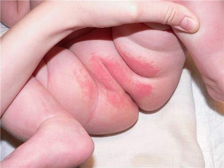 Вульвовагиноз у маленьких девочек — особенности протекания