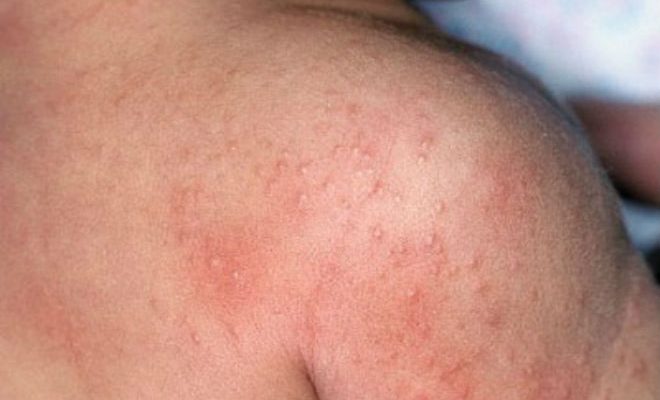 Что такое аллергический дерматит? Симптомы и способы лечения распространенной болезни