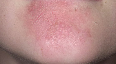 Раздражение на лице, покраснение и шелушение может быть признаком аллергической реакции кожи на внешний раздражитель