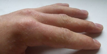 Водянистая сыпь на пальцах рук у ребенка thumbnail