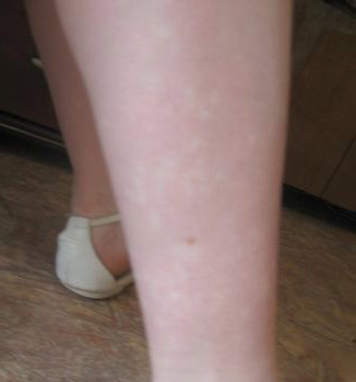 Почему появляются светлые или белые пятна на коже ног 