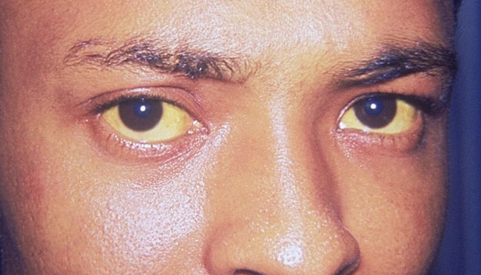 Причины желтого и коричневого цвета лица: проводим своевременную диагностику