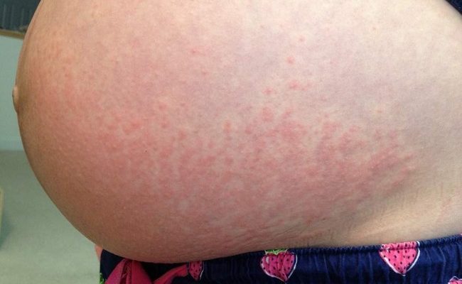 Почему появилась сыпь на животе при беременности? Лечение проблемы в зависимости от причины