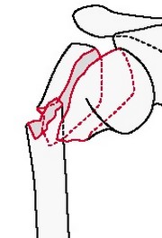 Внесуставной бифокальный перелом плечевой кости со смещением суставной поверхности