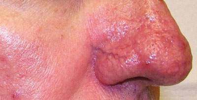 Покраснение и шелушение кожи на лице вокруг носа у мужчин thumbnail