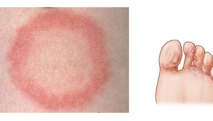 Что такое дерматофития гладкой кожи и ногтей? Симптомы и лечение