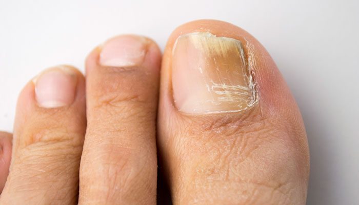 Заразен ли и как передается грибок ногтей на ногах и руках? Отвечаем на популярные вопросы