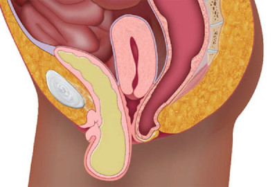 Проблемы с мочевым пузырем у женщин – симптомы фото