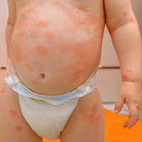 Почему появляются у ребёнка красные пятна на теле и что это за болезнь