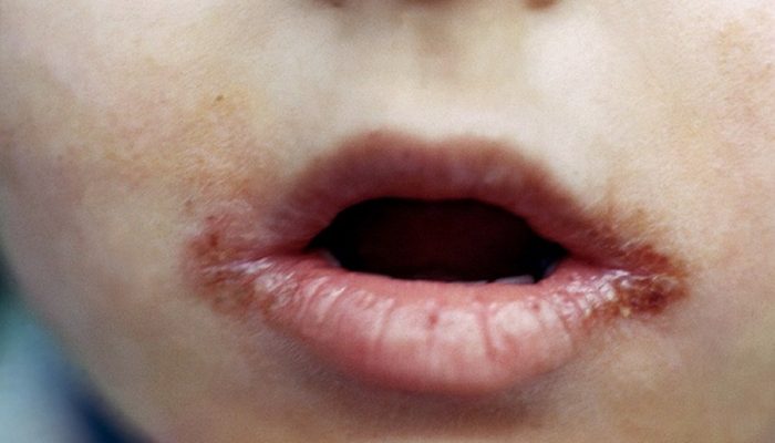 Дерматит на губах (хейлит): лечение