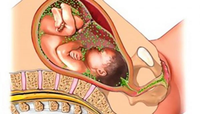 Как протекает хламидиоз при беременности? Симптомы, осложнения и методы лечения