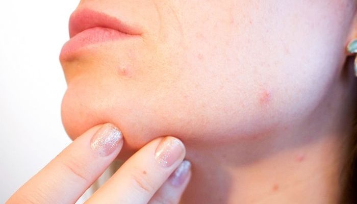 Лечение болячек на лице в зависимости от их причины